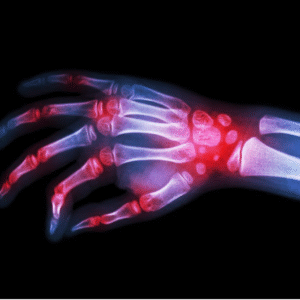 Arthritis Profile