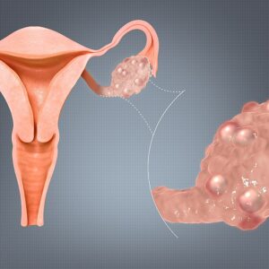 PCOS Profile - 1