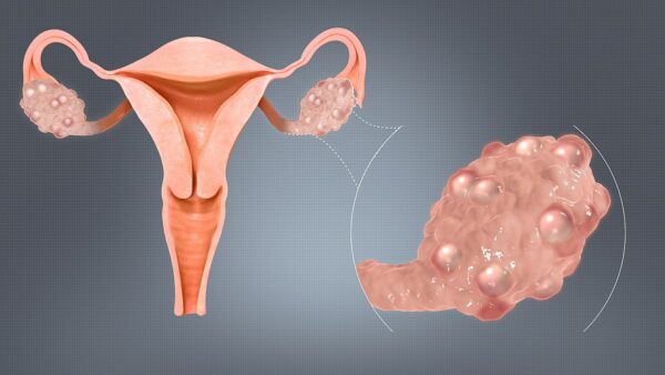 PCOS Profile - 1